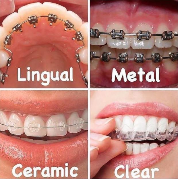 Advantages of Dental Aligners