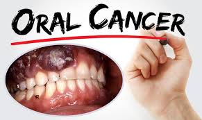 Oral Cancer