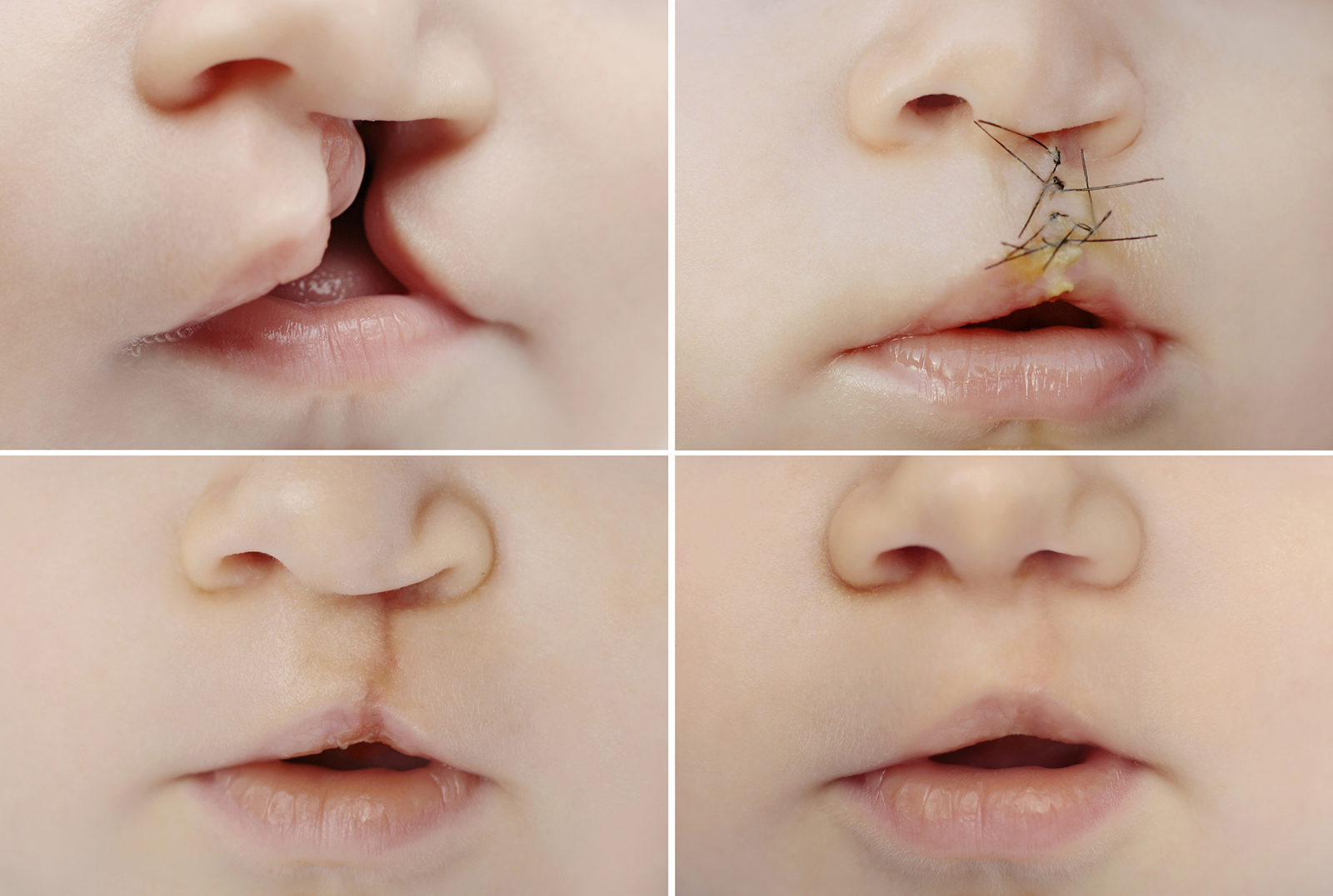 Cleft Lip and Palate