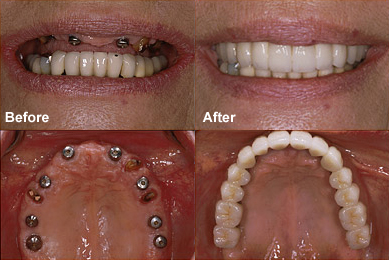 dental Implant